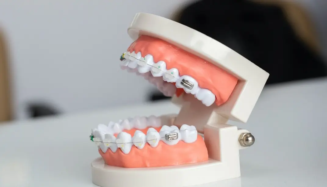 All Types of Braces and Their Prices in Malaysia: A Complete Guide