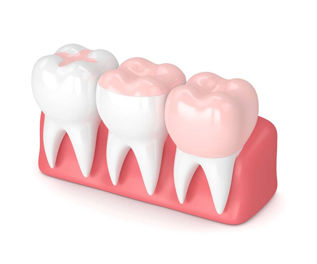 Pansement dentaire Plombadent : refermez un plombage ou amalgame