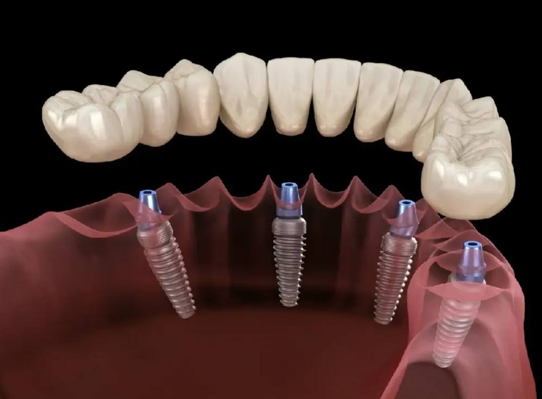 Dental Implants In Istanbul Your Complete Guide Ilajak Medical 7502