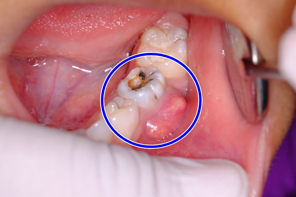 خراج الأسنان ما أعراضه و كيف يتم علاجه علاجك الطبية