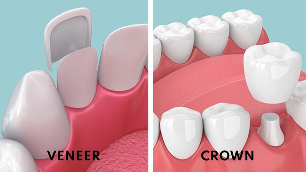 Veneers Vs Crowns: Similarities And Differences | ILAJAK Medical