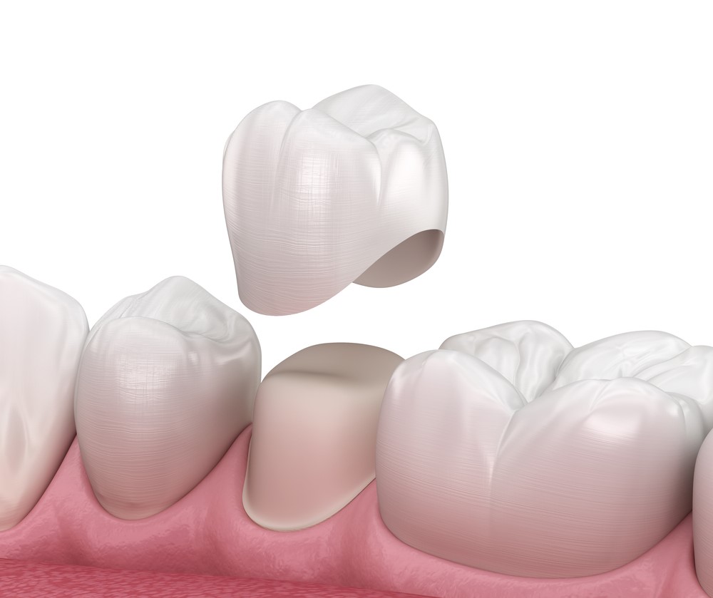 Couronne dentaire et bridge : avantages, types et prix