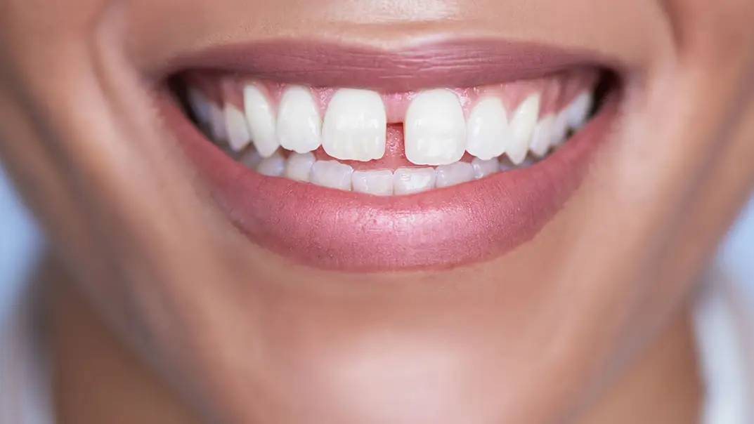 Best Ways To Fix Teeth Gap Without Braces ILAJAK Medical