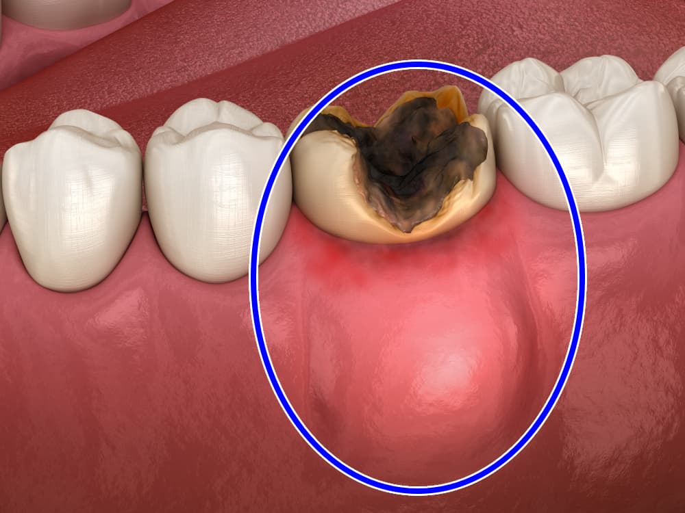 خراج الأسنان ما أعراضه و كيف يتم علاجه علاجك الطبية