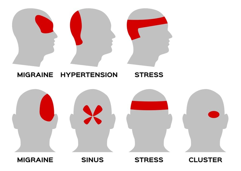 What are the 9 common types of headaches? ILAJAK Medical