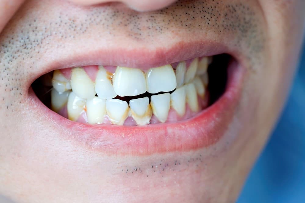 tartar-root-causes-and-how-it-affects-teeth-and-gum-ilajak