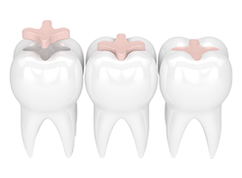 Plombage Dentaire Turquie Prix 2022 - Eternes Clinic